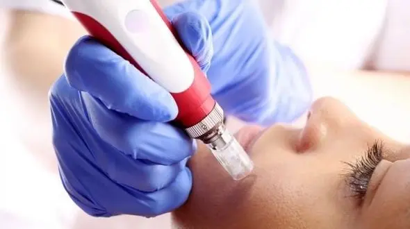 میکرونیدلینگ چیست و چه تاثیراتی در زیبایی پوست دارد؟