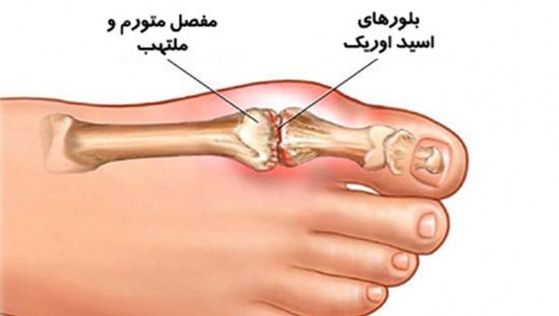 بافت پا در نقرس