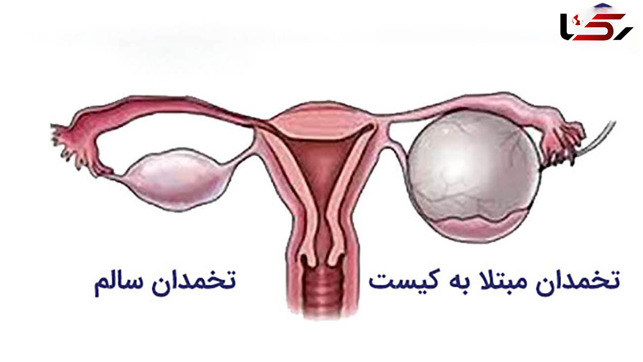 روش‌های پیشگیری و درمان کیست تخمدان