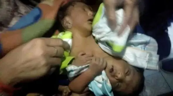 تولد دوقلوهای به هم چسبیده عجیب / پسر و دختر بودن آنها معلوم نیست ! + عکس