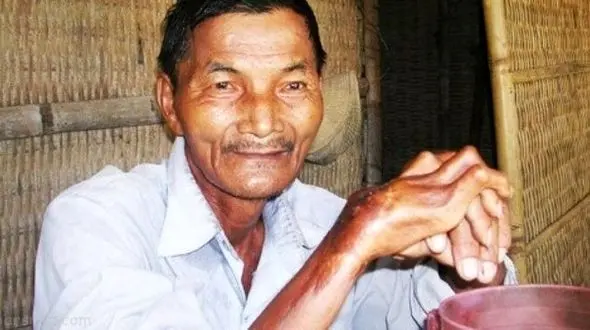 تصویر مردی که 43 سال نخوابید