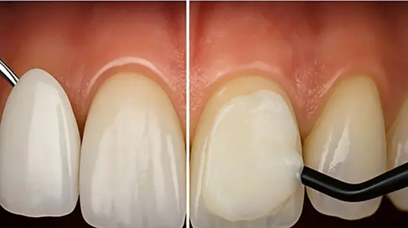 آیا لمینت و کامپوزیت برای همه مناسب است؟