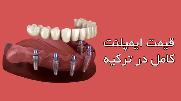 قیمت ایمپلنت کامل در ترکیه چقدر است ؟