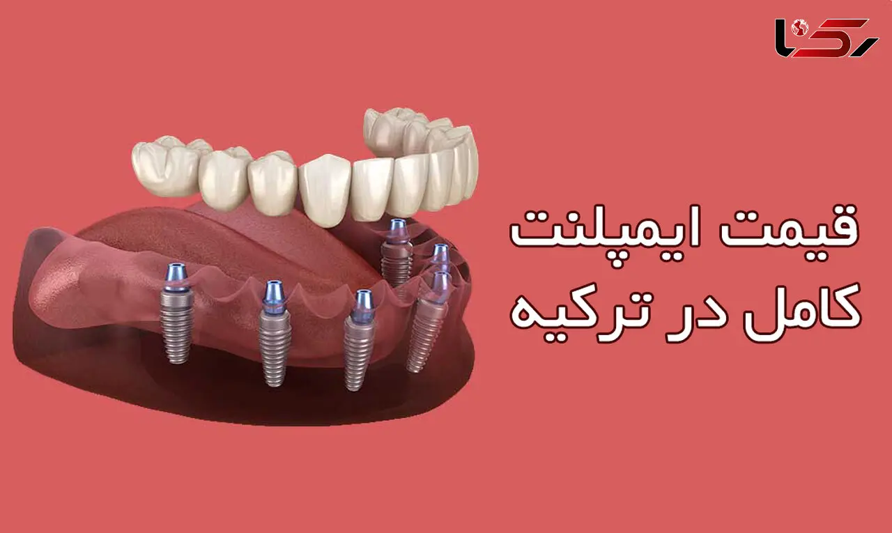 قیمت ایمپلنت کامل در ترکیه چقدر است ؟