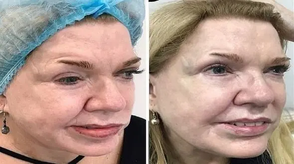معجزه تزریق بوتاکس برای یک زن + عکس قبل و بعد