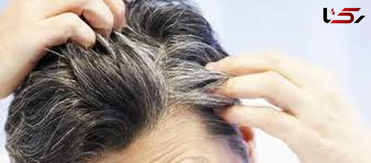 سفیدی مو زنگ خطر یک بیماری خطرناک در مردان