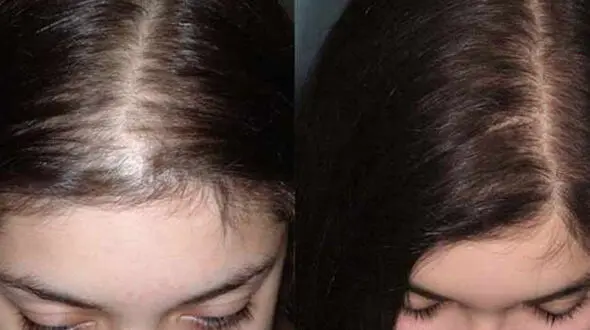 عوارض کاشت مو برای زنان