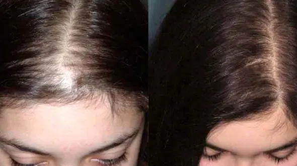 عوارض کاشت مو برای زنان