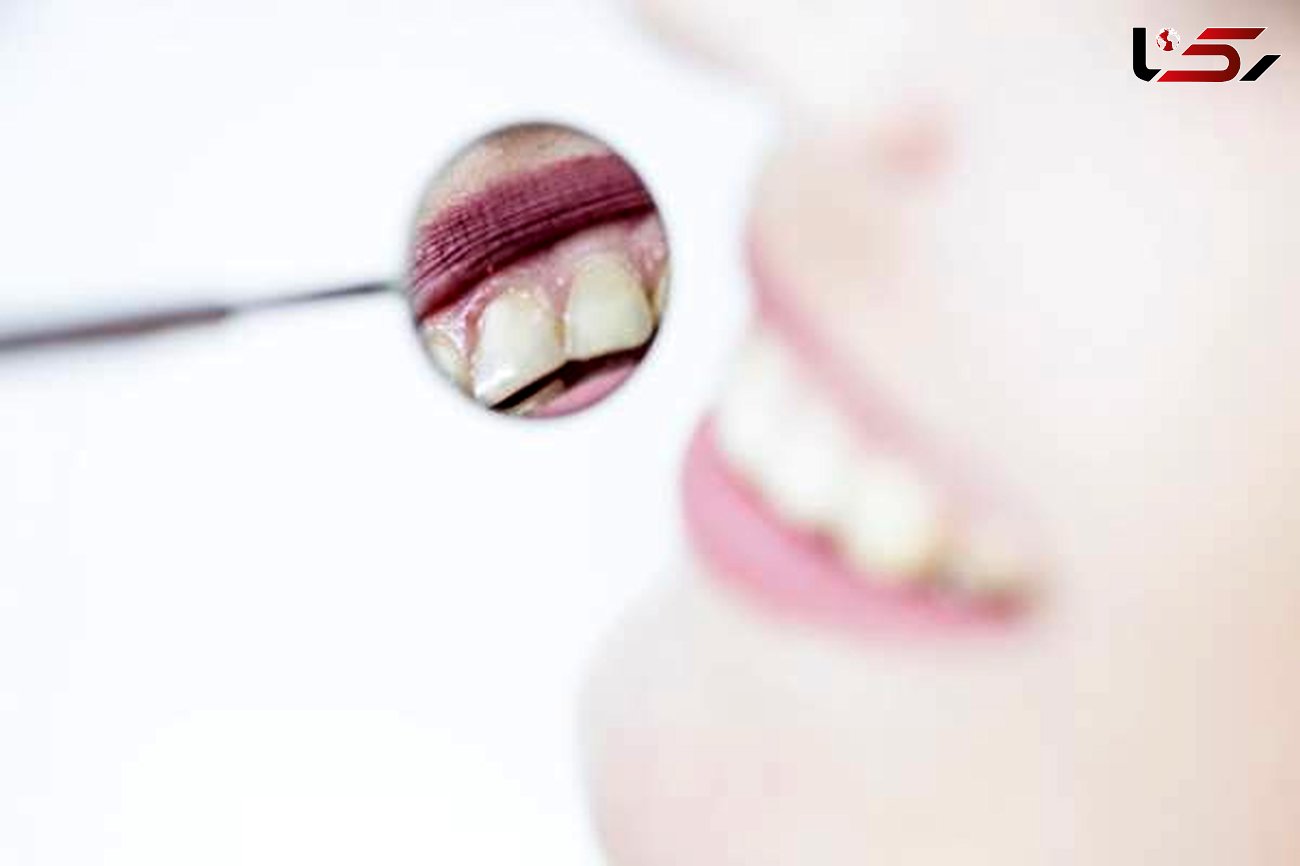 عوارض لمینت دندان رابشناسید