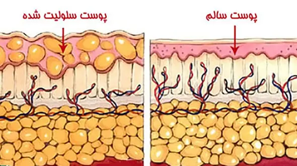 سلولیت چیست؟ / راهکارهای پیشگیری از سلولیت + جداول مربوط