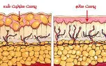 سلولیت چیست؟ / راهکارهای پیشگیری از سلولیت + جداول مربوط