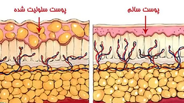 سلولیت چیست؟ / راهکارهای پیشگیری از سلولیت + جداول مربوط