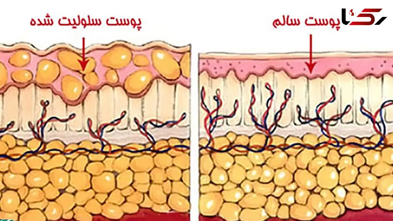 سلولیت چیست؟ / راهکارهای پیشگیری از سلولیت + جداول مربوط