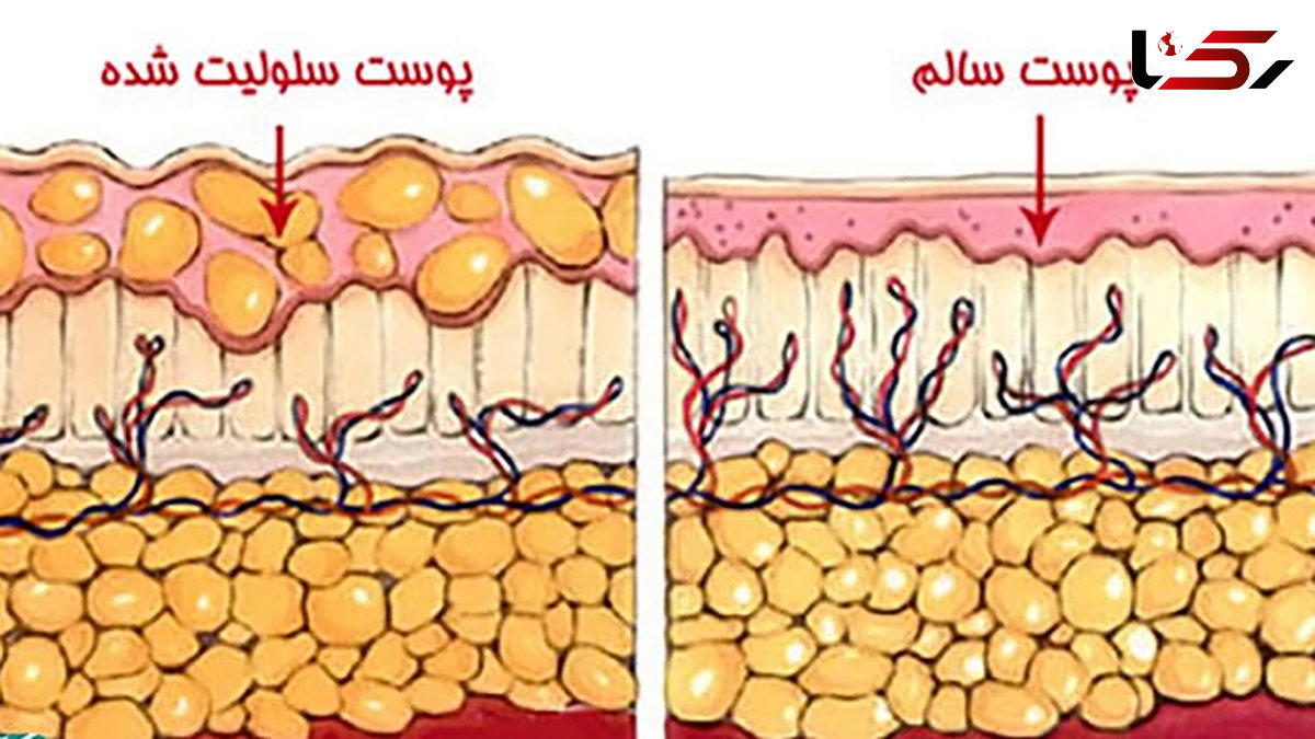 سلولیت چیست؟ / راهکارهای پیشگیری از سلولیت + جداول مربوط