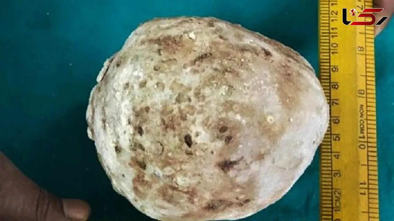 خارج کردن سنگ یک کیلویی از مثانه یک مرد+عکس