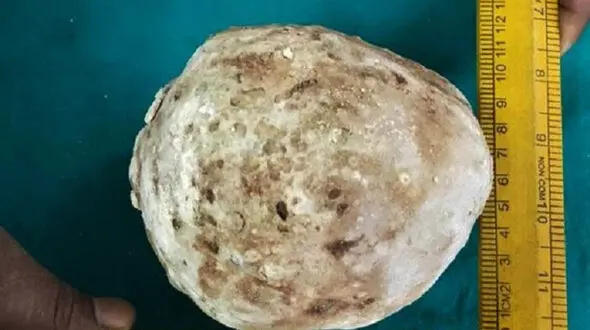 خارج کردن سنگ یک کیلویی از مثانه یک مرد+عکس