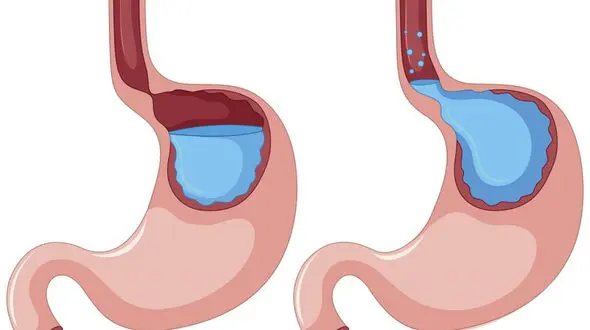 رفلاکس معده چیست؟ / فیلم