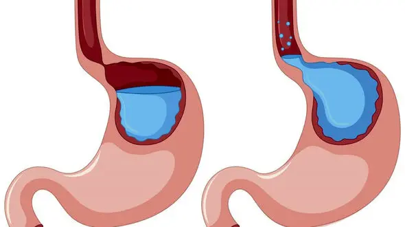 رفلاکس معده چیست؟ / فیلم