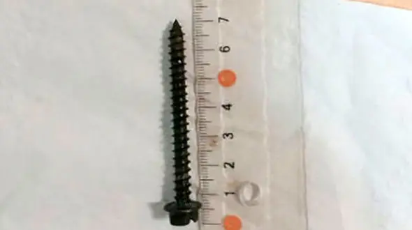 خارج کردن شی هولناک از معده کودک بوشهری+ عکس
