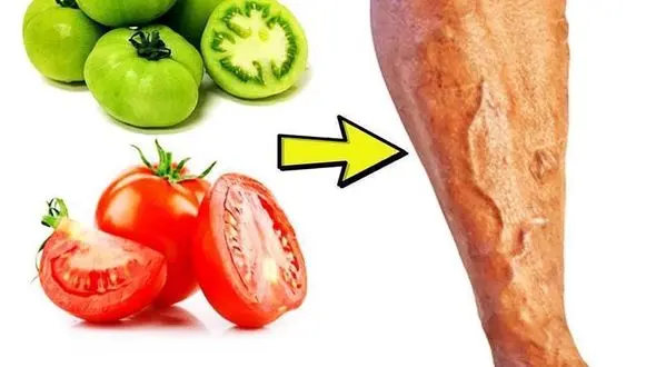 گوجه فرنگی داروی افراد درگیر واریس