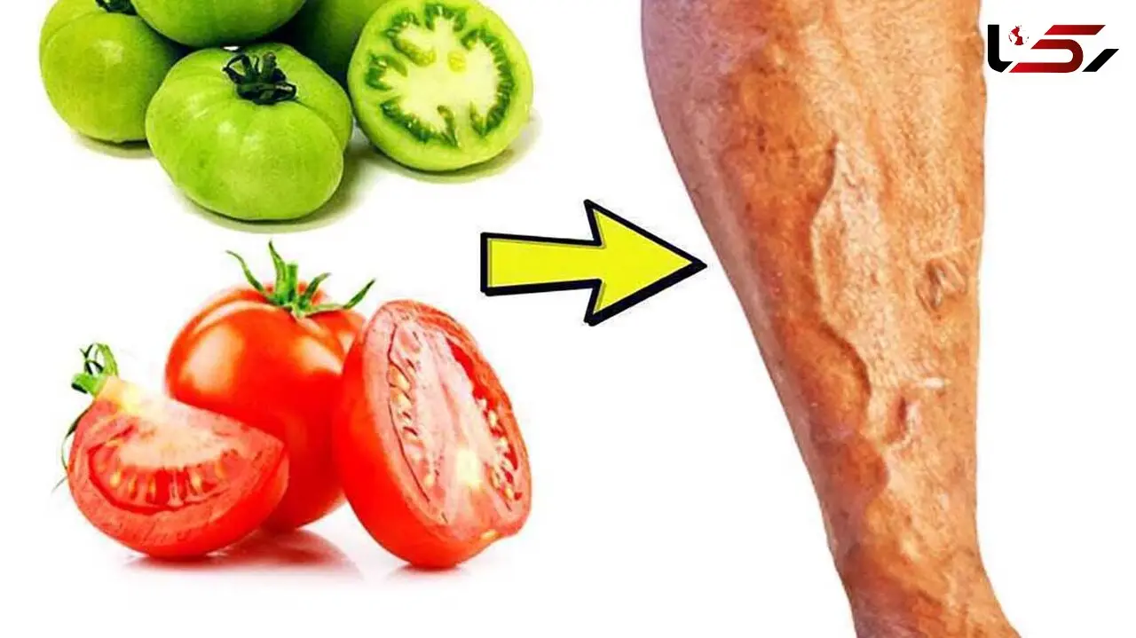 گوجه فرنگی داروی افراد درگیر واریس