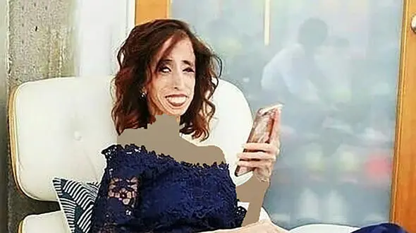 زشت ترین دختر جهان، بازهم زیباست! / زمان تولد یک گرم وزن داشت ! + عکس ها