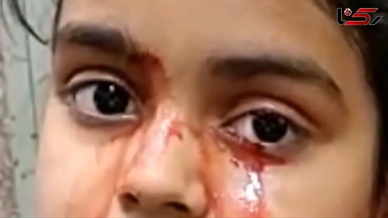 دختری 11 ساله به جای اشک خون گریه می کند + عکس