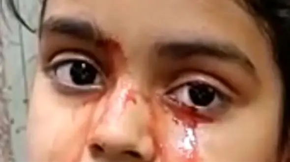 دختری 11 ساله به جای اشک خون گریه می کند + عکس