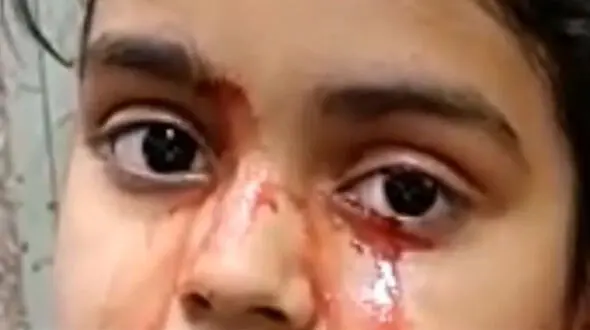 دختری 11 ساله به جای اشک خون گریه می کند + عکس