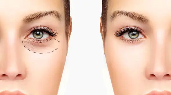 افتادگی پلک چشم + دلایل ایجاد 