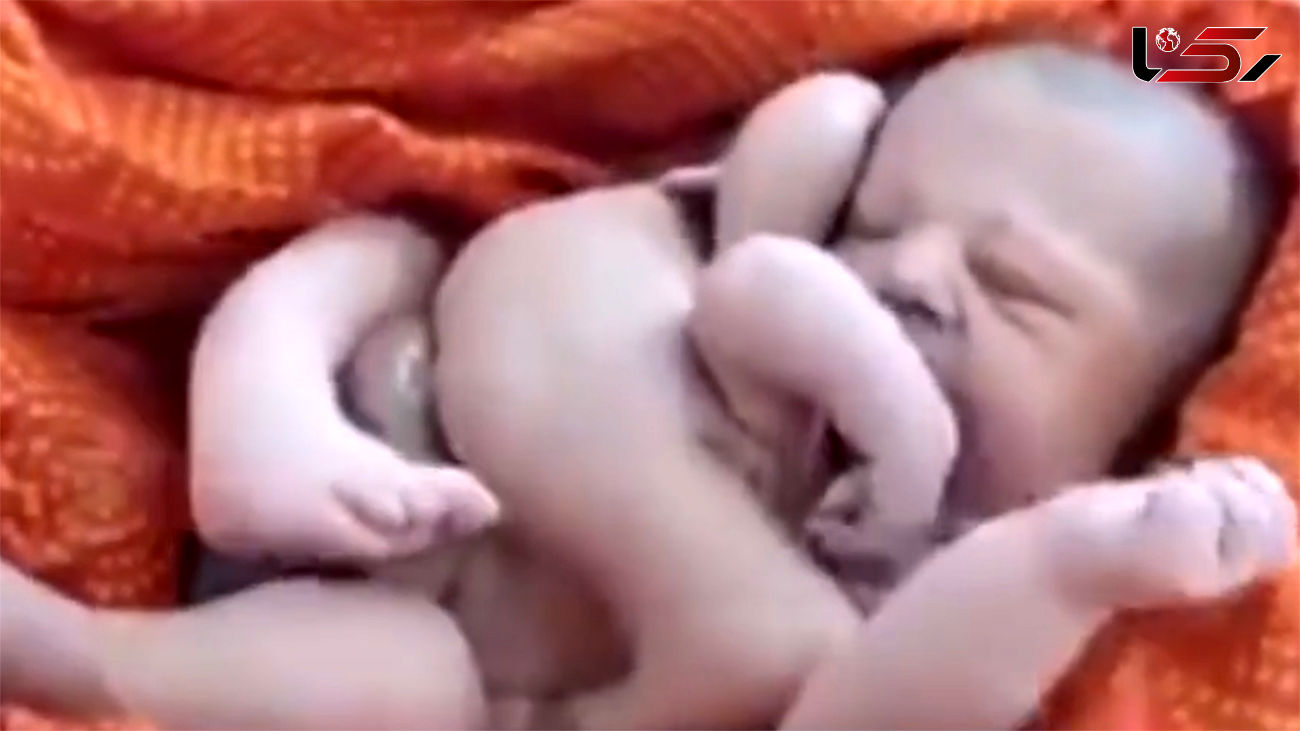 ببینید / تولد عجیب ترین نوزاد با 8 دست و پا + فیلم 