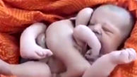 ببینید / تولد عجیب ترین نوزاد با 8 دست و پا + فیلم 
