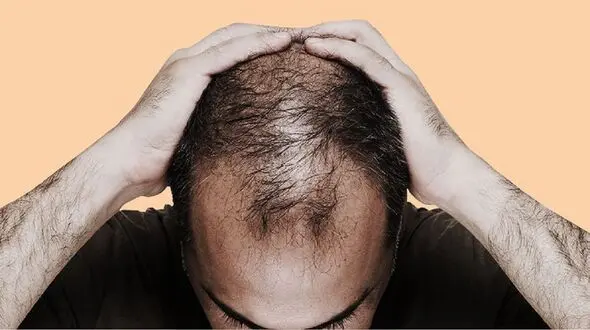 متهم‌های ردیف اول ریزش مو را بشناسید+ اینفوگرافی
