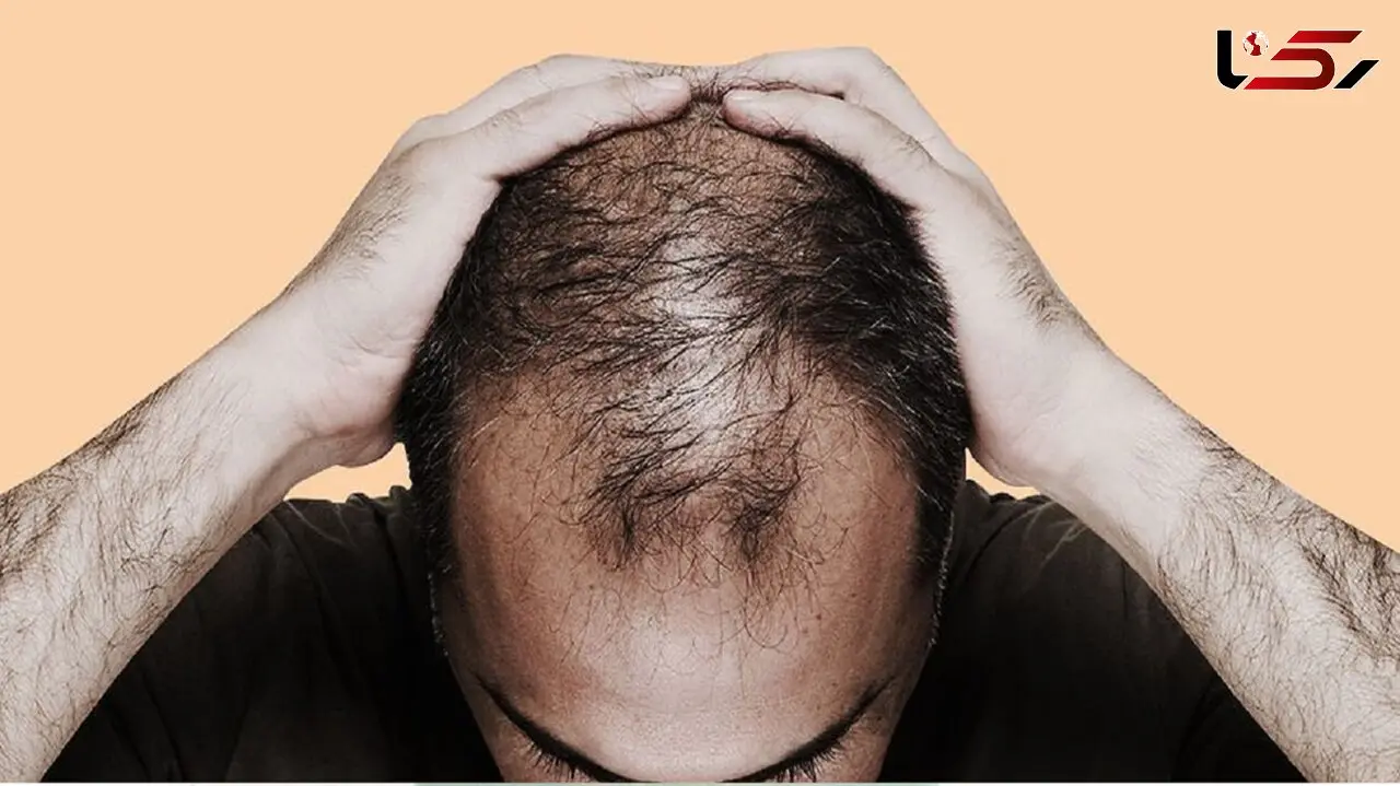 متهم‌های ردیف اول ریزش مو را بشناسید+ اینفوگرافی
