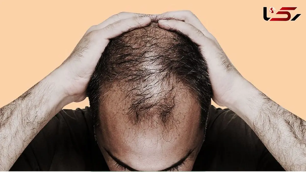 متهم‌های ردیف اول ریزش مو را بشناسید+ اینفوگرافی
