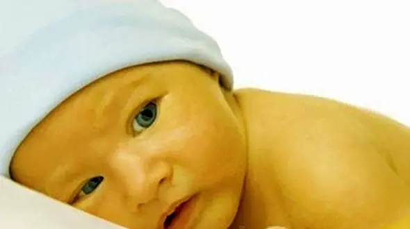 درمان زردی بچه