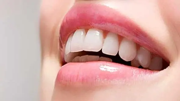 لمینت دندان سلبریتی‌ها دردسرساز شد