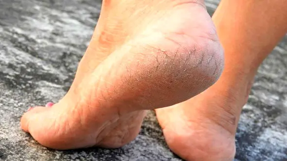 درمان های خانگی ترک پا