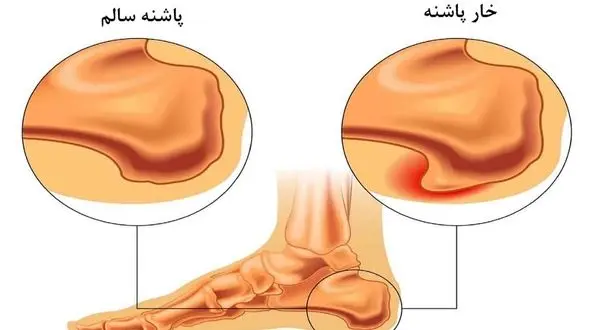 این بیماری را هنوز مردم نمی شناسند و جدی نمی گیرند!