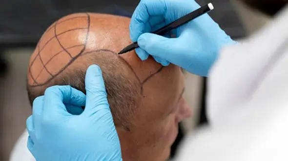 بهترین کشور برای کاشت مو کجاست؟