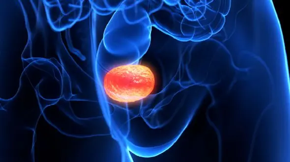 علائم اولیه سرطان مجاری ادراری و راه‌ های پیشگیری