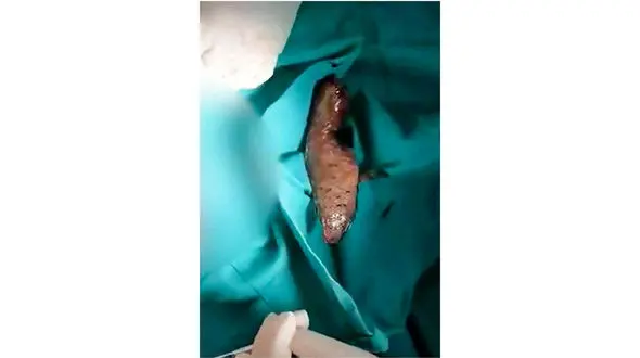 مرد 30 ساله شکمش با یک ماهی بالا آمد + عکس عجیب