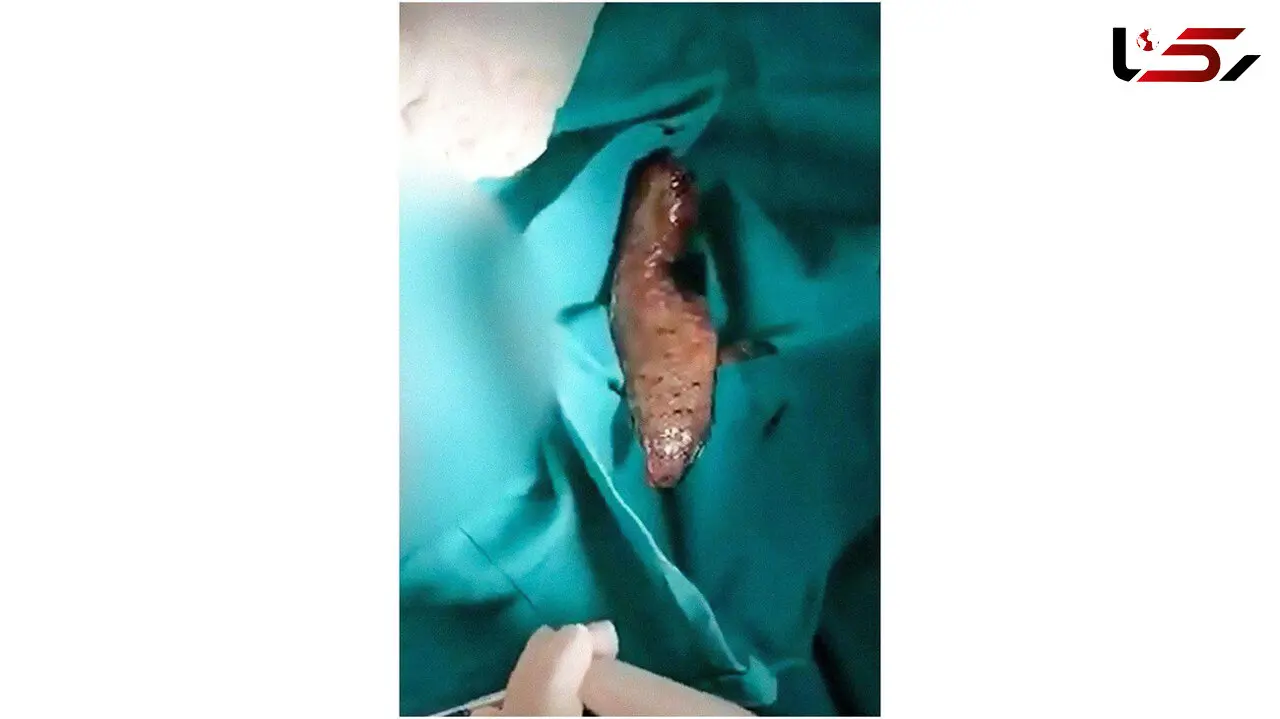 مرد 30 ساله شکمش با یک ماهی بالا آمد + عکس عجیب