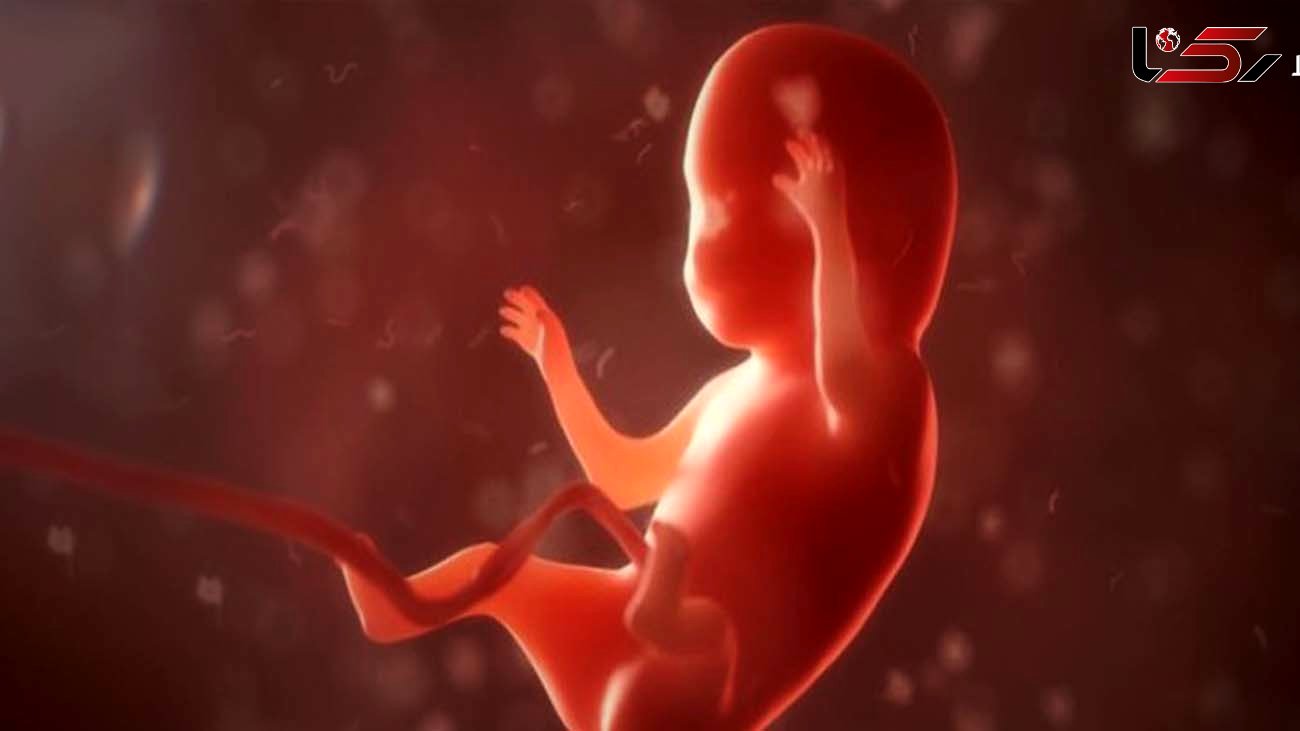 جلوگیری مجلس از سقط جنین ناقص الخلقه