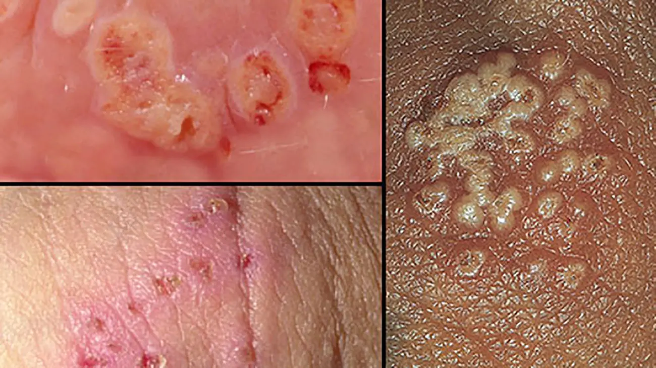 شکل ظاهری تبخال مقعدی