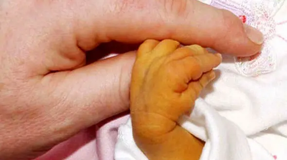  به دنیا آمدن نوزادی عجیب الخلقه + عکس حیرت آور