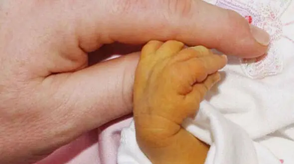  به دنیا آمدن نوزادی عجیب الخلقه + عکس حیرت آور