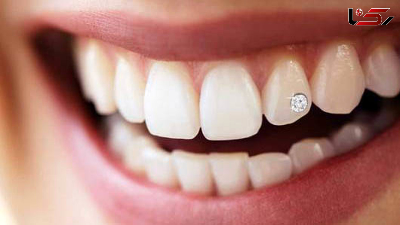 عوارض مهم و کلیدی کاشت نگین روی دندان 