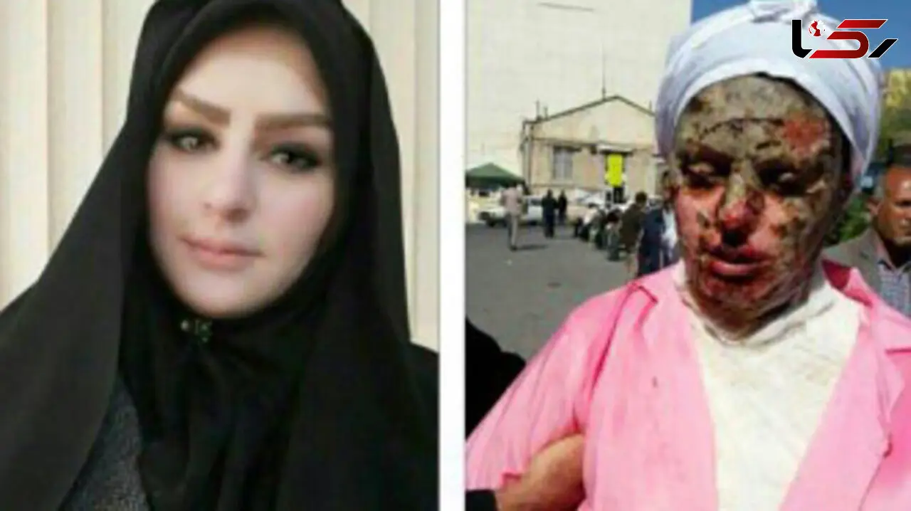 آخرین عکس از دختر زیبای تبریزی که با اسید سوخت! + جزییات