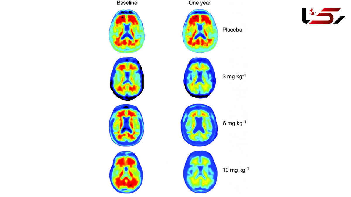 Novel Form of Alzheimer's Protein Found in Spinal Fluid Indicates Stage of Disease 